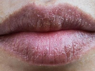 Τα σκασμένα ή ξεφλουδισμένα χείλη και η απώλεια μαλλιών αποτελούν ενδείξεις ανεπάρκειας ψευδαργύρου