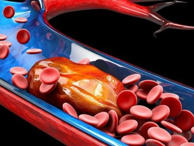 Πώς θα καταλάβετε τη διαφορά μεταξύ μελανιών και θρόμβων αίματος