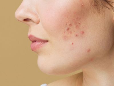 Ακμή: Ποιες κατηγορίες τροφών πρέπει να αποφεύγετε και γιατί (εικόνες)