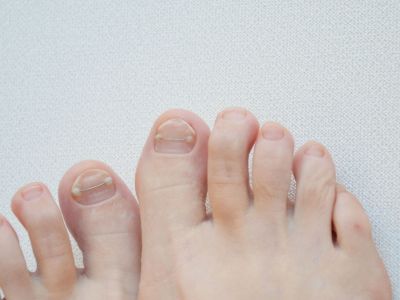 Πώς να απαλλαγείτε από τα κίτρινα νύχια των χεριών και των ποδιών