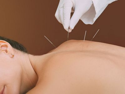 Ο βελονισμός μπορεί να βοηθήσει στην πρόληψη του διαβήτη τύπου 2, σύμφωνα με μελέτη