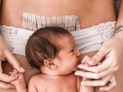 Τα 9 απαγορευμένα τρόφιμα μετά από την καισαρική τομή