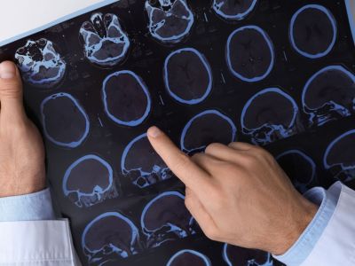 Σκλήρυνση κατά πλάκας: Ο ρόλος του βάρους στην εξέλιξη της νόσου