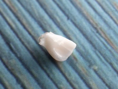 Ονειροκρίτης: Είδες στο όνειρό σου οτι χάνεις δόντια; Δες τι σημαίνει και ποιο μήνυμα κρύβει