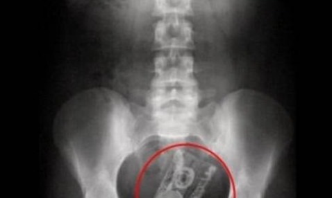 Τα πιο περίεργα αντικείμενα που βρέθηκαν μέσα σε σώματα ασθενών!