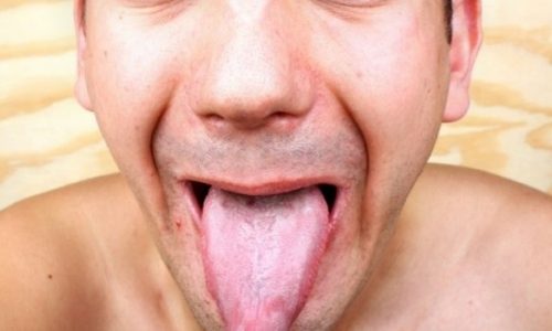 Καρκίνος στη γλώσσα: Πώς θα τον αναγνωρίσετε