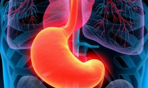 Υποφέρετε από έλκος; Τι πρέπει να προσέξετε στη διατροφή σας