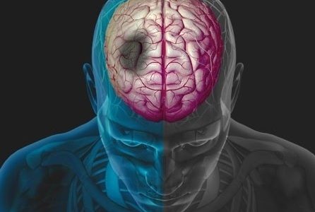 Εγκεφαλικό επεισόδιο: Τα 10 συνηθέστερα αίτια