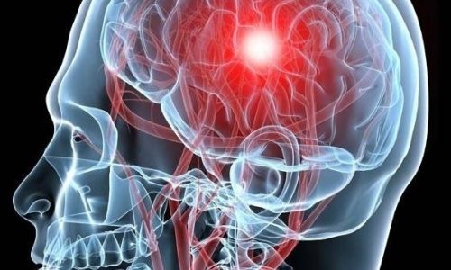 Ανεύρυσμα εγκεφάλου: Συμπτώματα, θεραπεία, αποκατάσταση