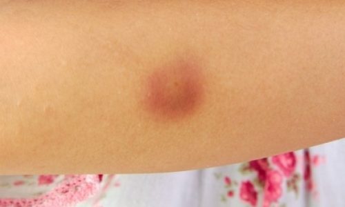 Πώς θα φύγει πιο γρήγορα η μελανιά