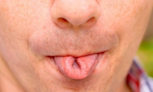 Κακοσμία στόματος: Μήπως φταίει η… γλώσσα σας; (φωτογραφίες)