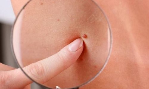 Τι σημαίνει για την υγεία ο αριθμός των ελιών στο σώμα - Δείτε αναλυτικά