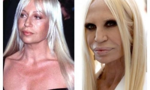 Αυτές είναι οι 10 χειρότερες παραμορφώσεις διασήμων από πλαστικές επεμβάσεις