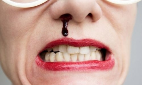 Ανεξήγητη ρινορραγία: Ποιες είναι οι συνηθέστερες αιτίες