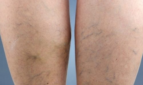 Φλεβική θρόμβωση: Παράγοντες κινδύνου και πρόληψη