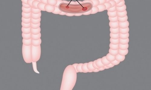 Το λαχανικό που προστατεύει από τον καρκίνο του εντέρου