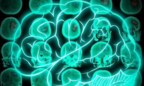 Mίνι εγκεφαλικό: Δείτε αν κινδυνεύετε, τώρα!