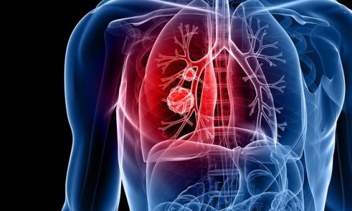 Καρκίνος πνεύμονα: 7 σημάδια που πιθανώς αγνοείτε (εικόνες)