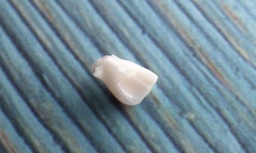 Ονειροκρίτης: Είδες στο όνειρό σου οτι χάνεις δόντια; Δες τι σημαίνει και ποιο μήνυμα κρύβει